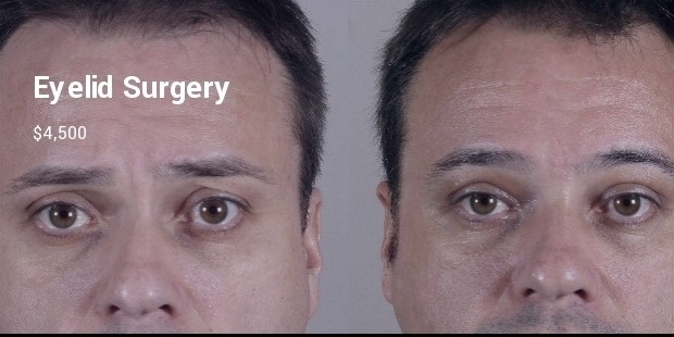 eyelid surgery