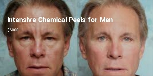 intensive chemical peels for men