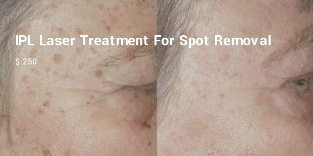 ipl laser treatment for spot removal