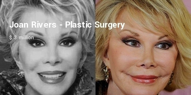 joan rivers  plastic surgery