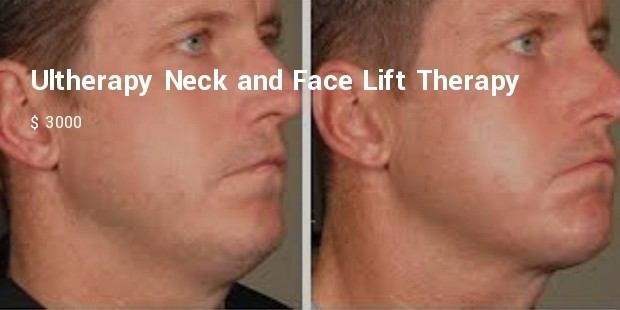 ultherapy neck and face lift therapy